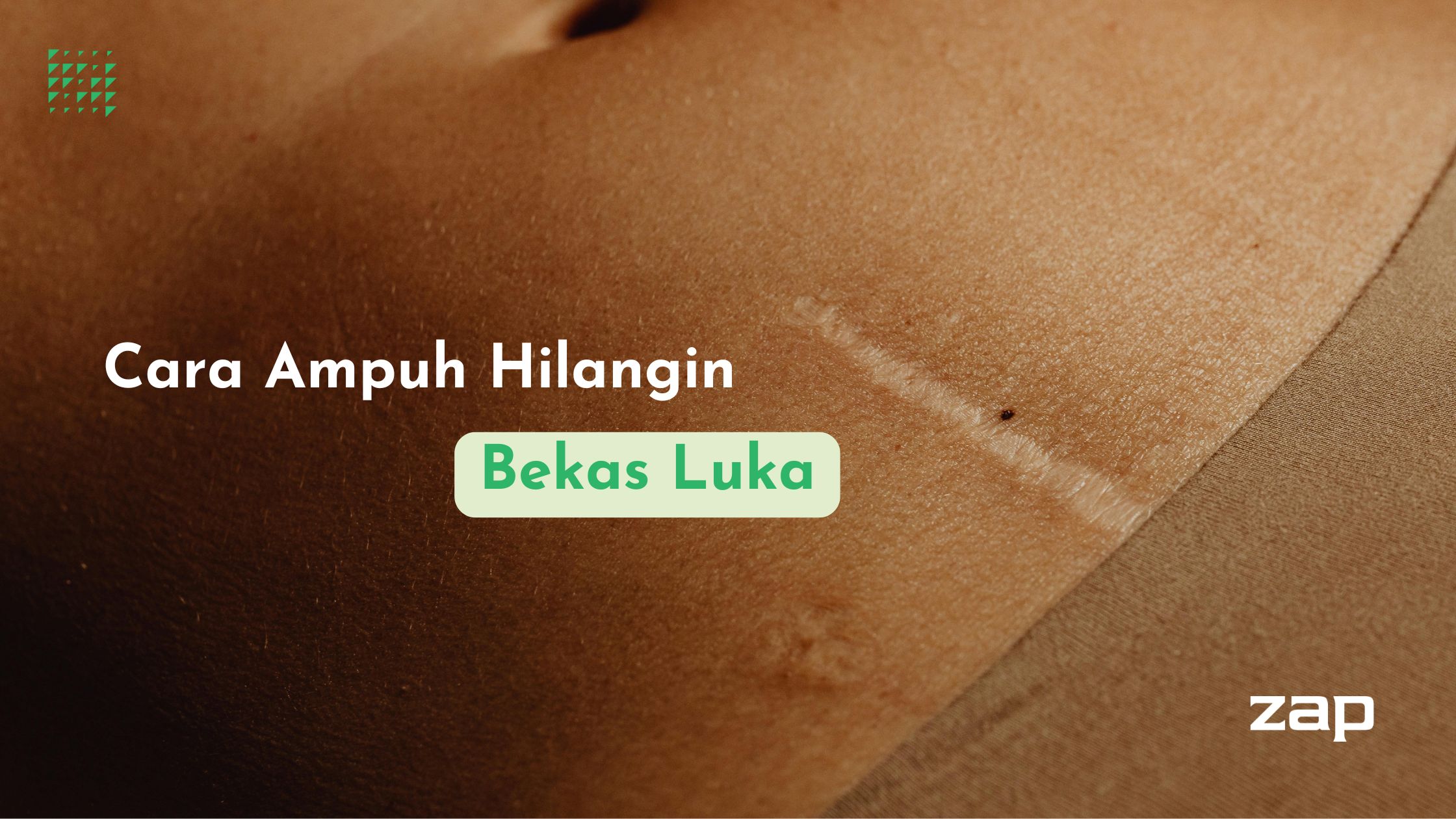 Cara Ampuh Hilangin Bekas Luka