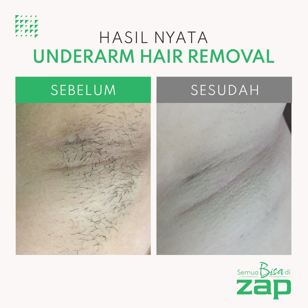 Lifetime Membership Underarm Hair Removal