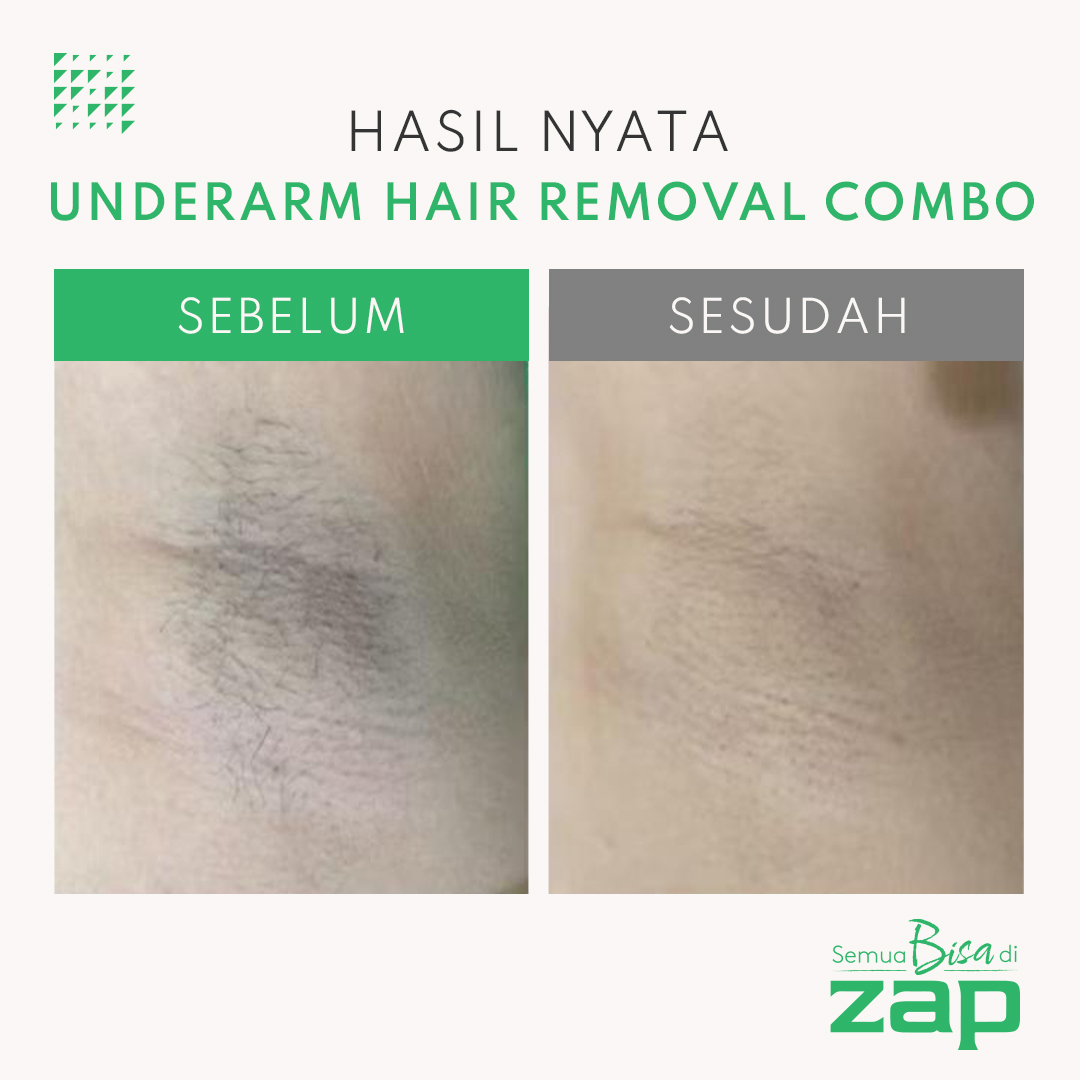 Lifetime Membership Underarm Hair Removal Combo