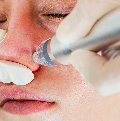 Facial Vacuum Hydro