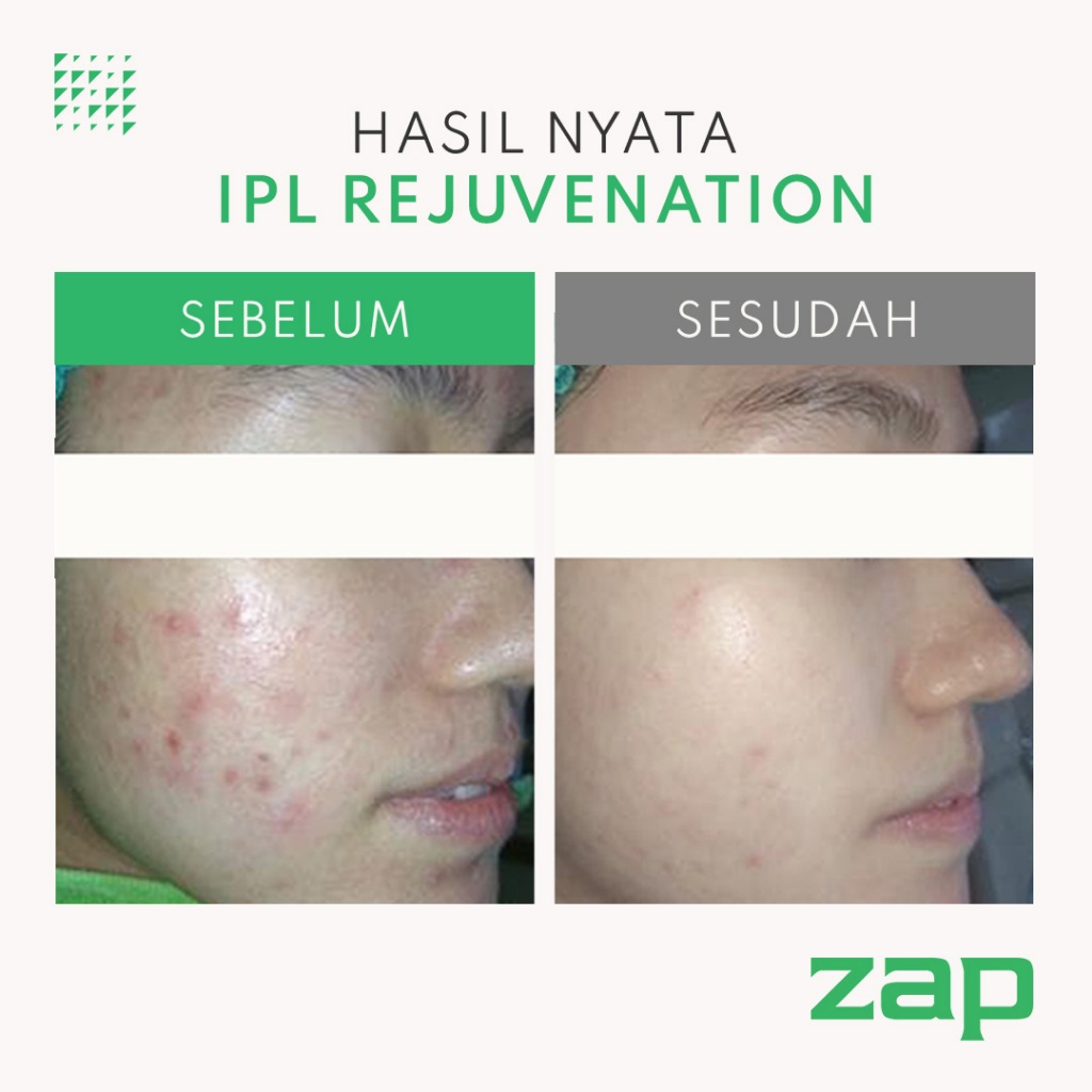 Laser Quasi Long Pulsed Acne + IPL Rejuvenation Double (250 shot) + Peeling Acne + Oxy Infusion + Pharmacy Cream Acne Package