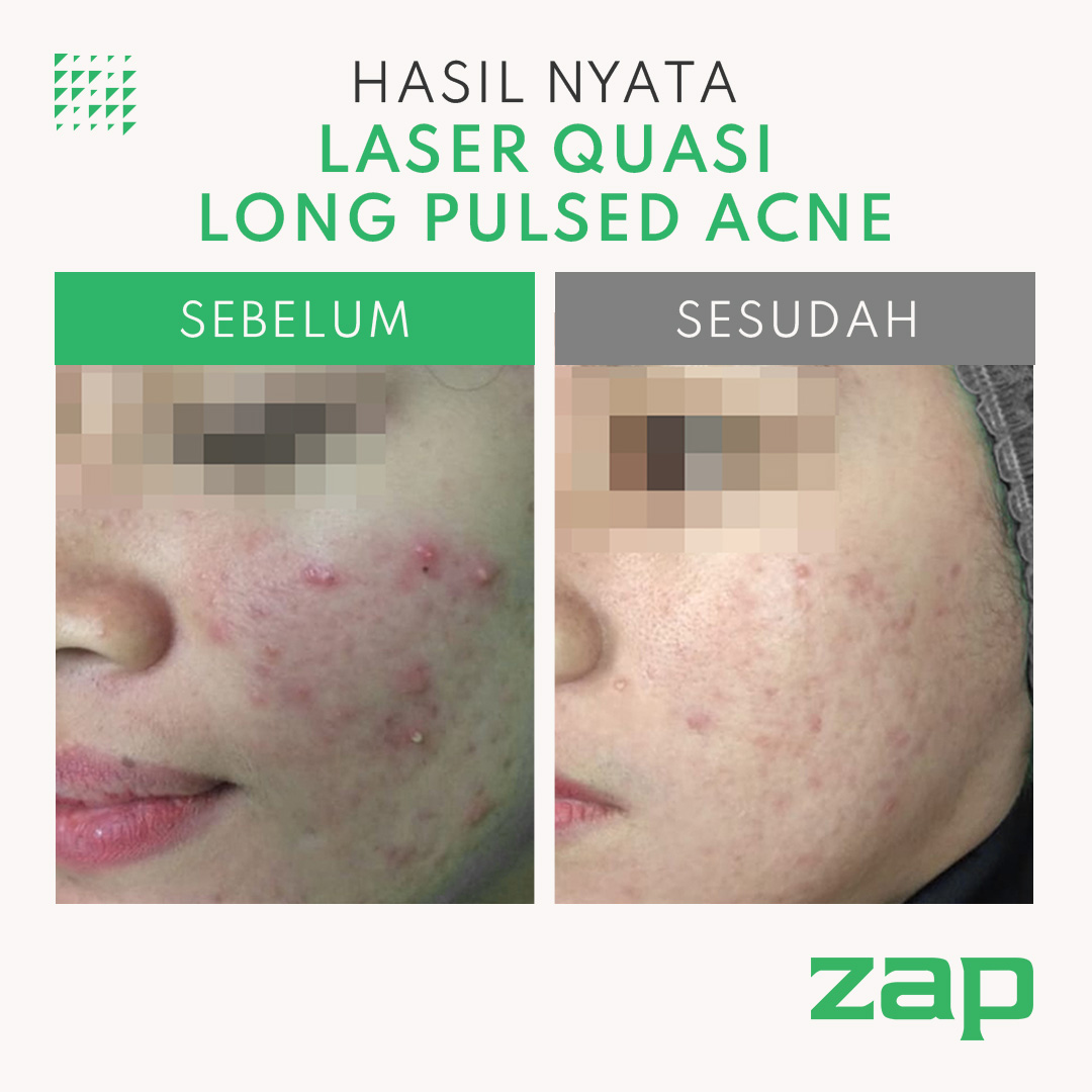 Laser Quasi Long Pulsed Acne + IPL Rejuvenation Double (250 shot) + Peeling Acne + Oxy Infusion + Pharmacy Cream Acne Package